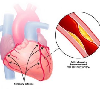 coronary-artery-fat-deposits-e1643706821626