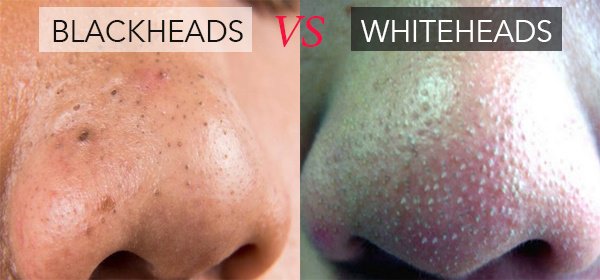 blackheads vs whiteheads