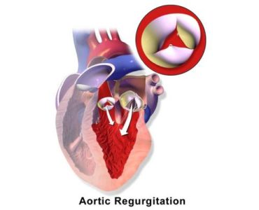 aortic insufficiency