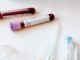 test tube blood sample/ Serum Iron Test